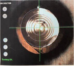 Trifocal lens centered on visual axis.