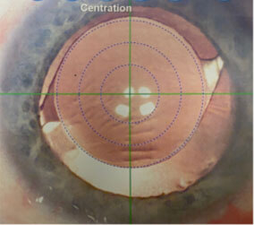 Single vision intraocular lens centered on the visual access with the Verion system.