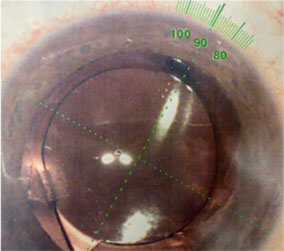 Astigmatism correcting intraocular lens aligned on the correct axis with the Verion system.