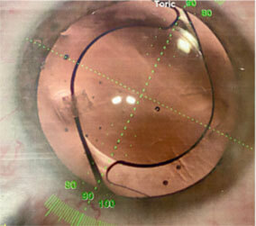 Astigmatism correcting Intraocular lens precisely aligned along visual axis with the Verion system.