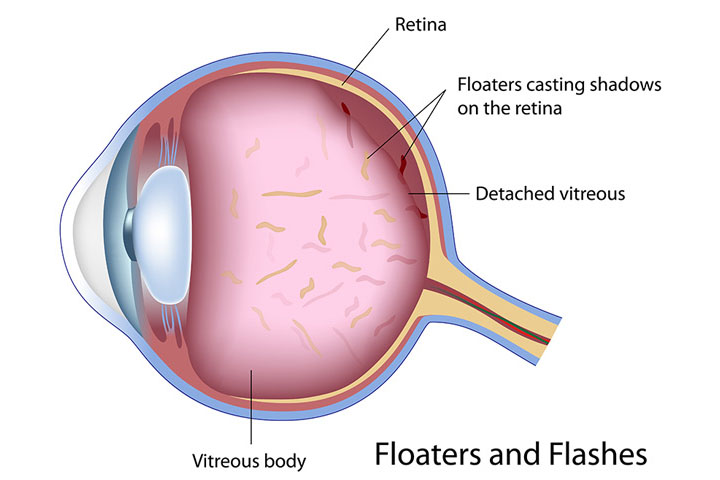 Flashes and Floaters Diagram