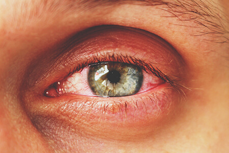 conjunctivitis in an eye