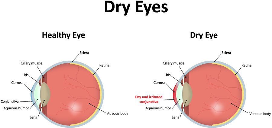 Chart Illustrating a Healthy Eye vs One Experiencing Dry Eye