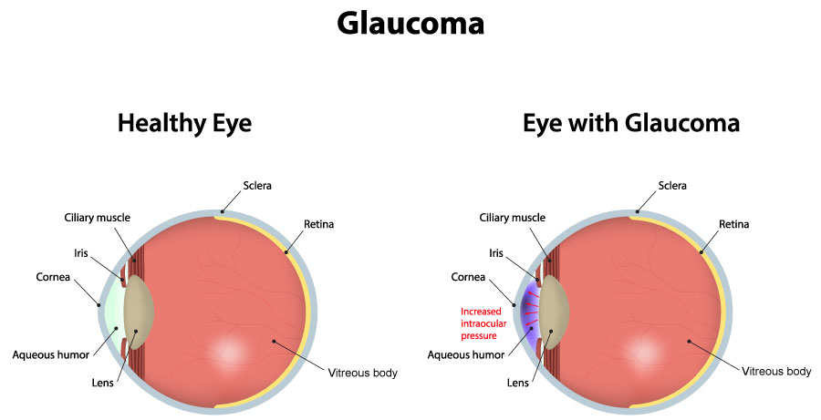 Chart Illustrating a Healthy Eye vs One With Glaucoma